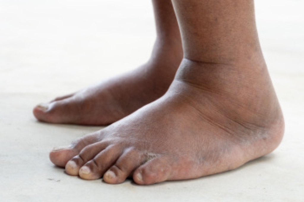 Swollen Feet Can Signal Something More