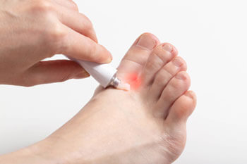 Athletes foot treatment in the Tarrant County: Arlington, Fort Worth, Haltom City, Euless, Bedford, Dallas County: Dallas, Irving, Grand Prairie, Farmers Branch, Denton County: Flower Mound, Denton, Collin County: Plano, Garland areas