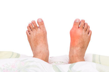 Bunions Treatment in the Tarrant County: Arlington, Fort Worth, Haltom City, Euless, Bedford, Dallas County: Dallas, Irving, Grand Prairie, Farmers Branch, Denton County: Flower Mound, Denton, Collin County: Plano, Garland areas