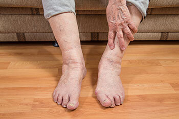 Geriatric foot care in the Tarrant County: Arlington, Fort Worth, Haltom City, Euless, Bedford, Dallas County: Dallas, Irving, Grand Prairie, Farmers Branch, Denton County: Flower Mound, Denton, Collin County: Plano, Garland areas