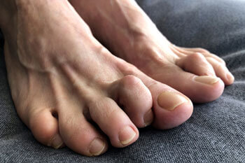 Hammertoe treatment in the Tarrant County: Arlington, Fort Worth, Haltom City, Euless, Bedford, Dallas County: Dallas, Irving, Grand Prairie, Farmers Branch, Denton County: Flower Mound, Denton, Collin County: Plano, Garland areas