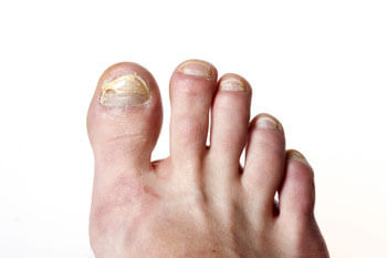 laser treatment