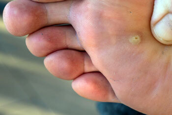 Plantar warts treatment in the Tarrant County: Arlington, Fort Worth, Haltom City, Euless, Bedford, Dallas County: Dallas, Irving, Grand Prairie, Farmers Branch, Denton County: Flower Mound, Denton, Collin County: Plano, Garland areas