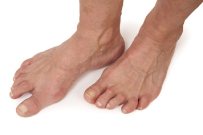 Rheumatoid Arthritis and Its Impact on the Feet