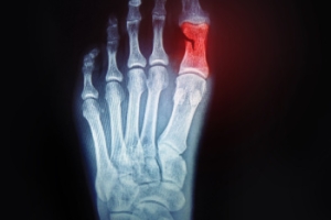 What Toe Fractures Are and How They Happen