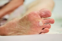 What Does A Plantar Wart Look Like?