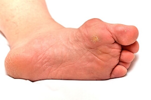 Where are Corns Located?