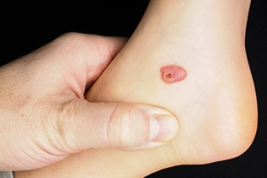 Causes of and Care for Foot Blisters