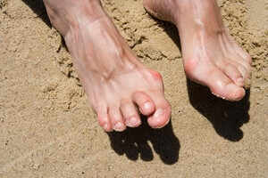 Do I Have Hammertoe?