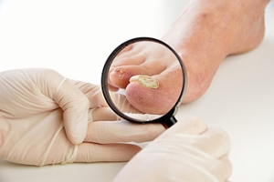 Recognizing a Fungal Toenail Infection