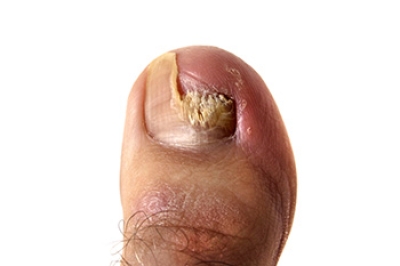 Causes and Symptoms of Toenail Fungus