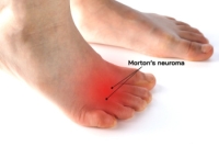 Challenges of Diagnosing Morton's Neuroma