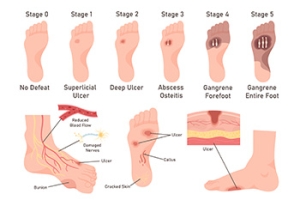Limb Salvage for Diabetic Patients With Foot Ulcers