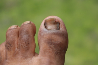Treating Toenail Fungus
