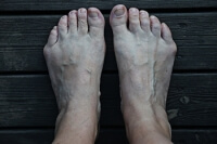 What is a Tailor’s Bunion?