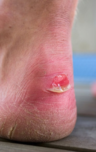 Blood blister in heel store