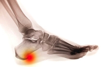 Causes of Heel Spurs