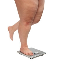 Foot Conditions Caused by Obesity