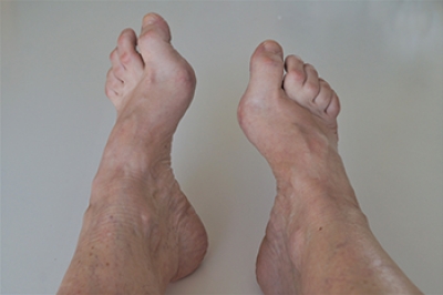 Causes and Potential Complications of a High Foot Arch